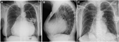 Case Report: The woman with the big heart—an imaging-guided attempt of surgical reduction